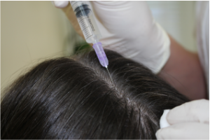 мезотерапия для роста волос, мезотерапия волосистой части головы
